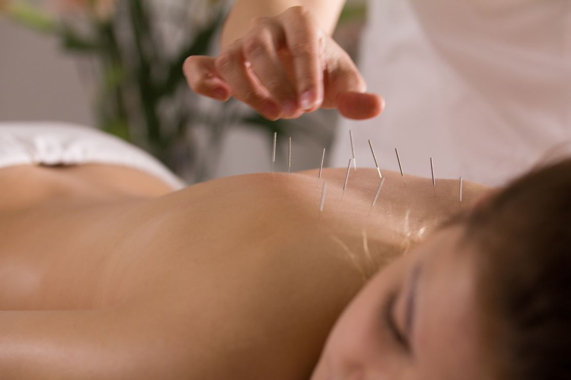 The photo shows Sophie performing acupuncture on a woman from Lake Wylie, focusing on meridian points to support women's health, including hormonal balance, fertility, and pain relief. Acupuncture also helps alleviate issues like sciatica and menopause symptoms, promoting overall wellness.