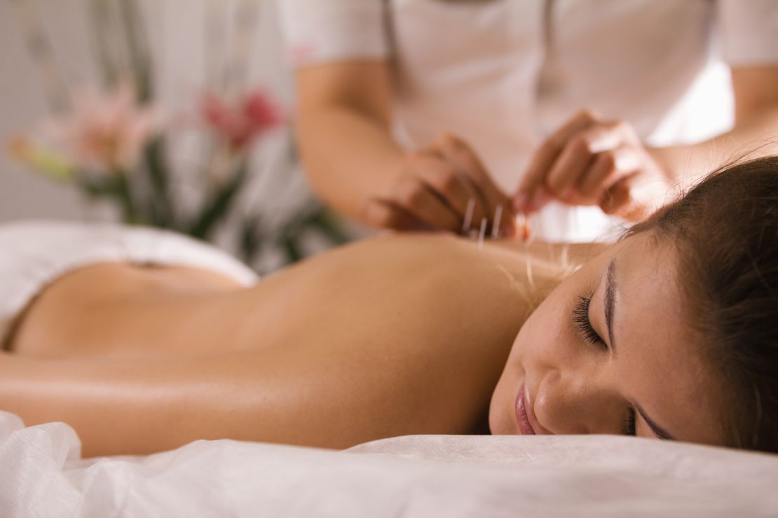 The photo shows Sophie performing acupuncture on a client from Pineville in a community acupuncture setting. Sophie is carefully inserting thin needles along specific points on the client’s back, demonstrating her expertise in traditional Chinese medicine. 