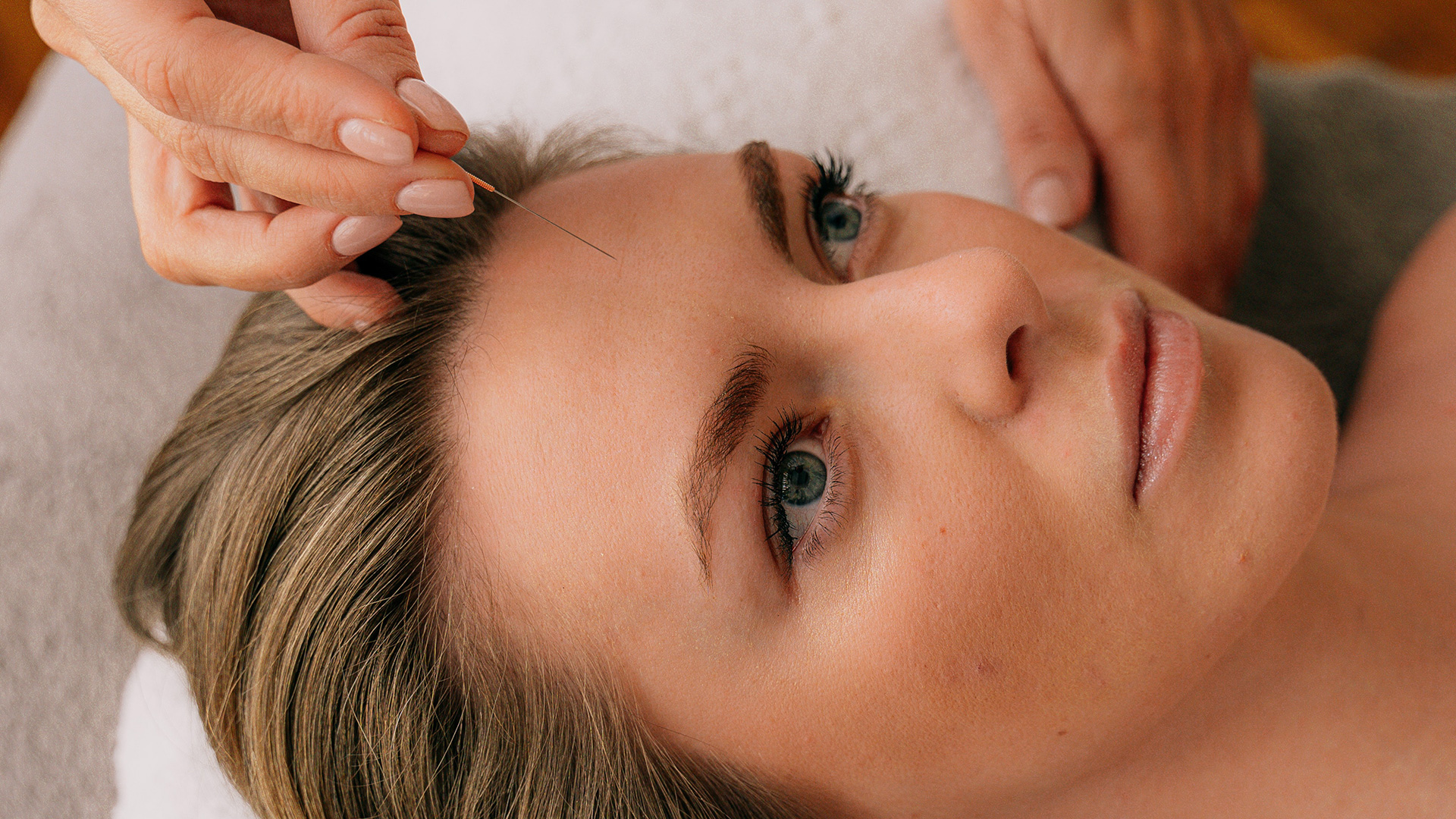 A woman from Ballantyne is peacefully lying on a treatment table while receiving acupuncture for anxiety. Thin, sterile acupuncture needles are gently placed along specific meridians of the body to help restore balance and reduce stress. 