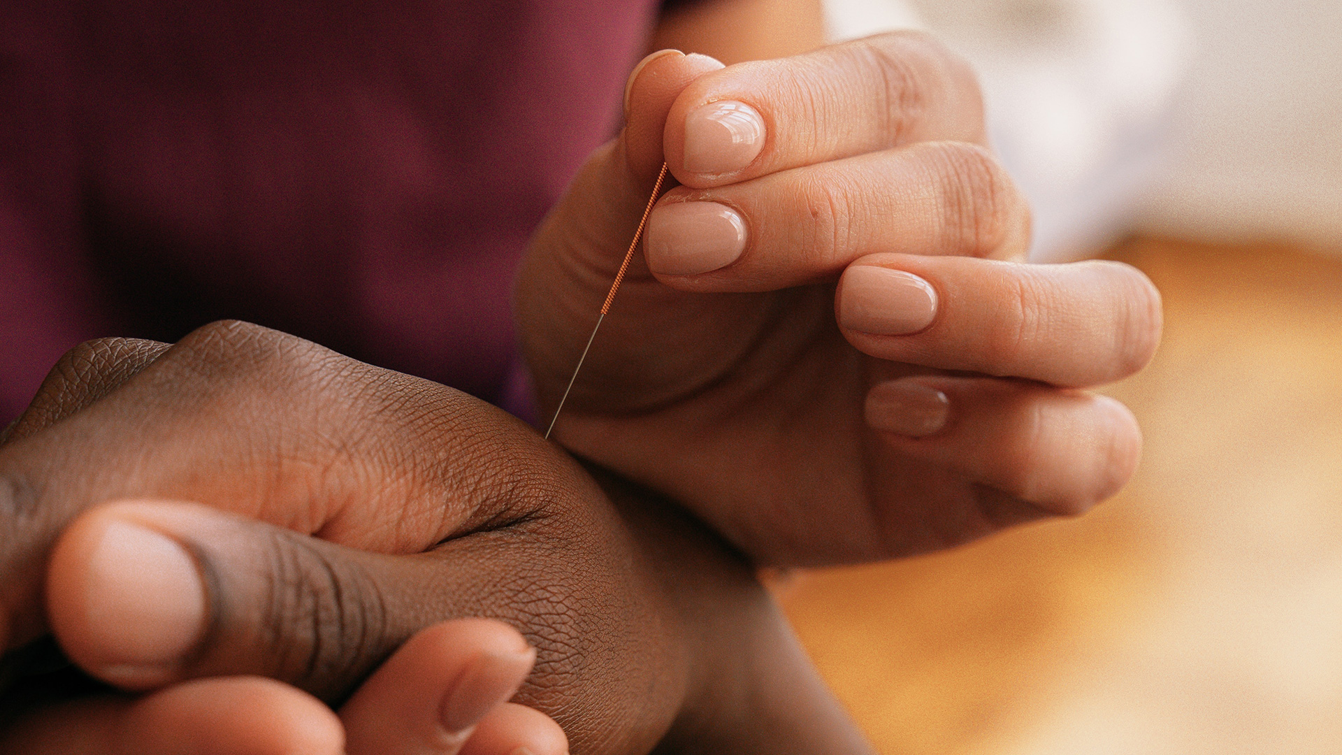 The photo shows Sophie performing acupuncture on a client from Steele Creek, with needles carefully inserted into specific pressure points on their hands. The focus is on targeting head pain and migraine pressure points to provide relief. 